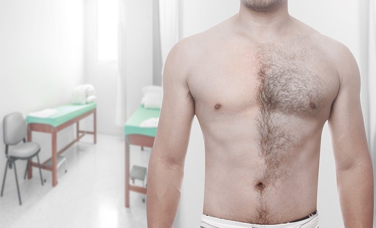 Epilazione uomo MES