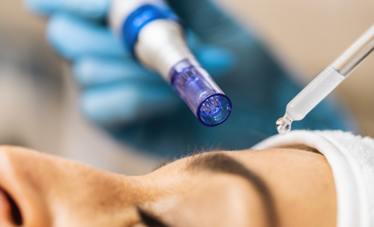 Microneedling MES Bozen