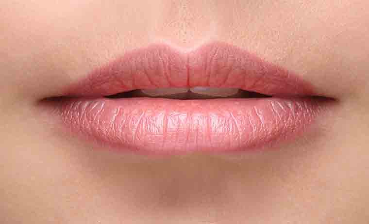 Filler labbra MES Filler labbra MES