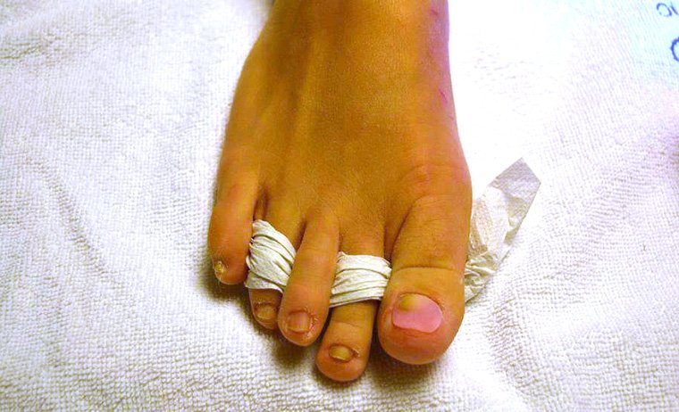 kaputte nägel nagelrekonstruktion