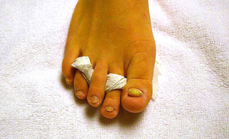 kaputte nägel nagelrekonstruktion