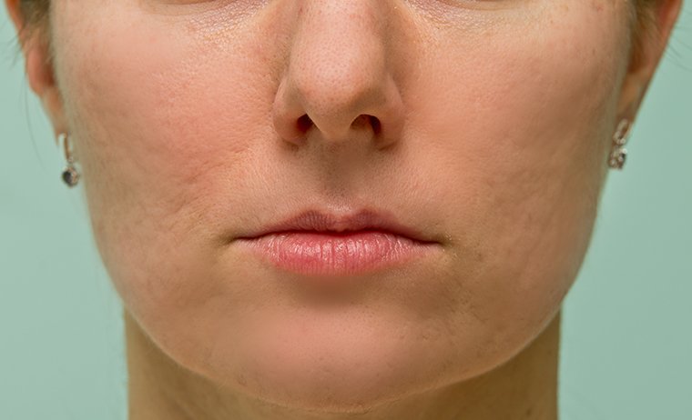 Microneedling MES Microneedling MES