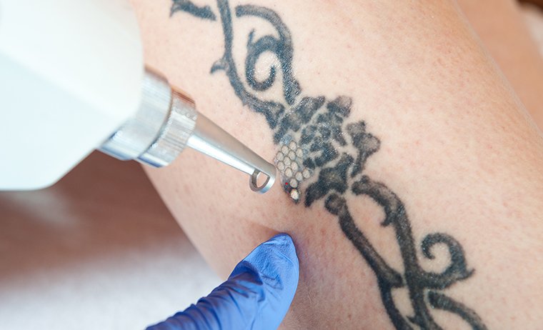 Tattooentfernung Laser MES