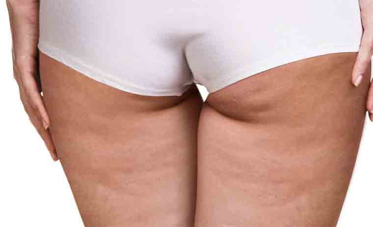 Velashape MES Velashape MES