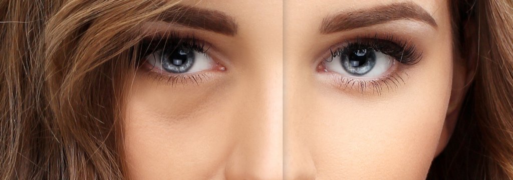 Blepharoplastik MES