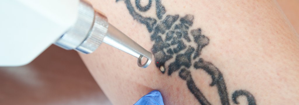 Rimozione tatuaggi con laser MES