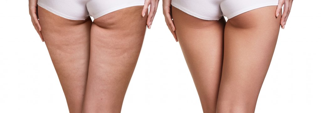 MES Velashape vela shape cellulitis