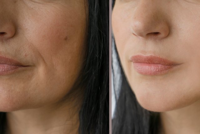 BIOREVITALISIERUNG BOZEN MES BEHANDLUNG