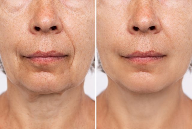 BIOREVITALISIERUNG BOZEN MES BEHANDLUNG