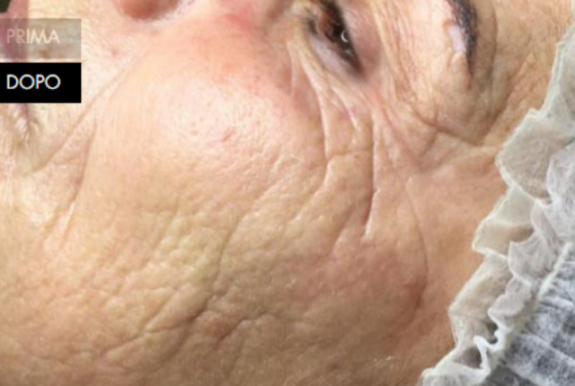 trattamento viso antiaging MES rhea bolzano