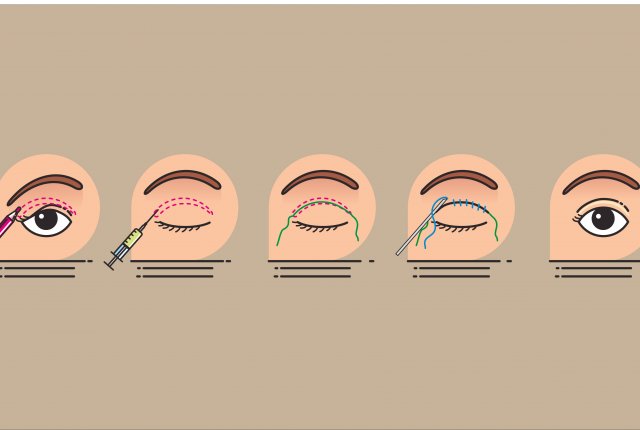 Blepharoplastik MES