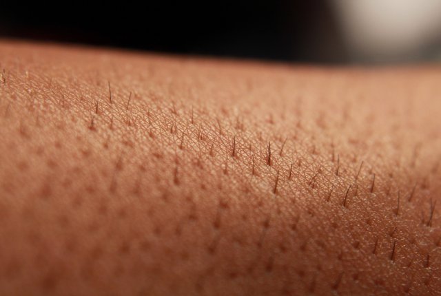 Epilazione definitiva MES