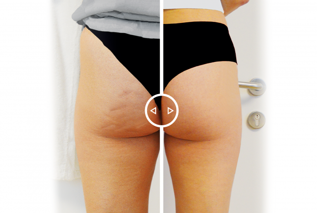 mes_sito_cellulite_prima_dopo_luglio_3000x2000_06_2019.png