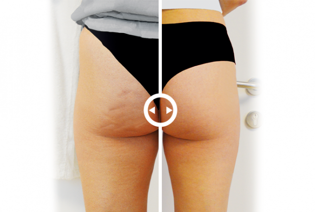 mes_sito_cellulite_prima_dopo_luglio_760x462_06_2019_1.png