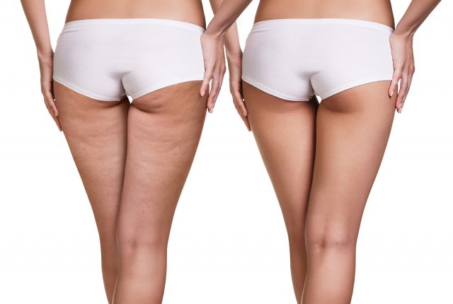 MES Velashape vela shape cellulitis