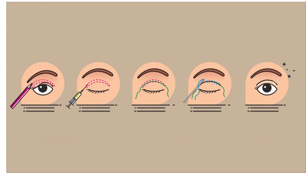 BLEPHAROPLASTIK / MES