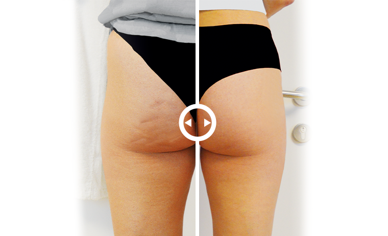 cellulite come sconfiggerla